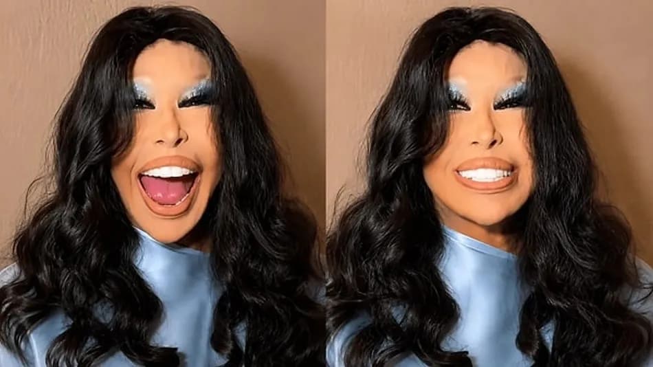 Bülent Ersoy'un Lolita Lift sonrası son hali gündem oldu