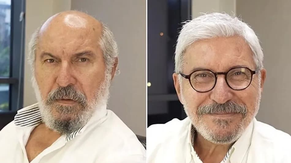 Hüseyin Soysalan'ın protez saçlı yeni imajı gündem oldu